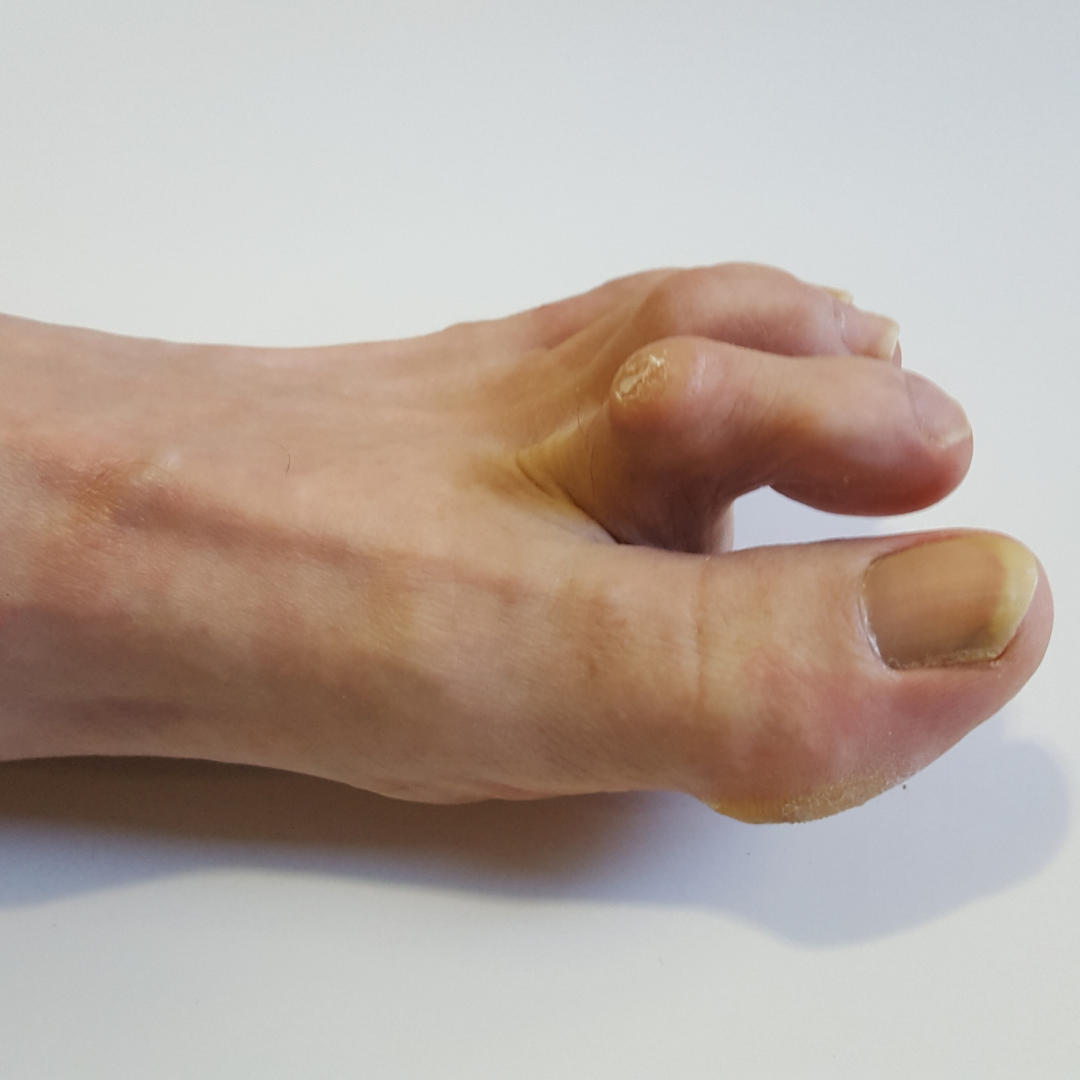 claw toes