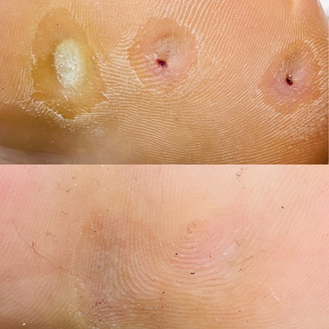 verruca on feet before and after treatment
