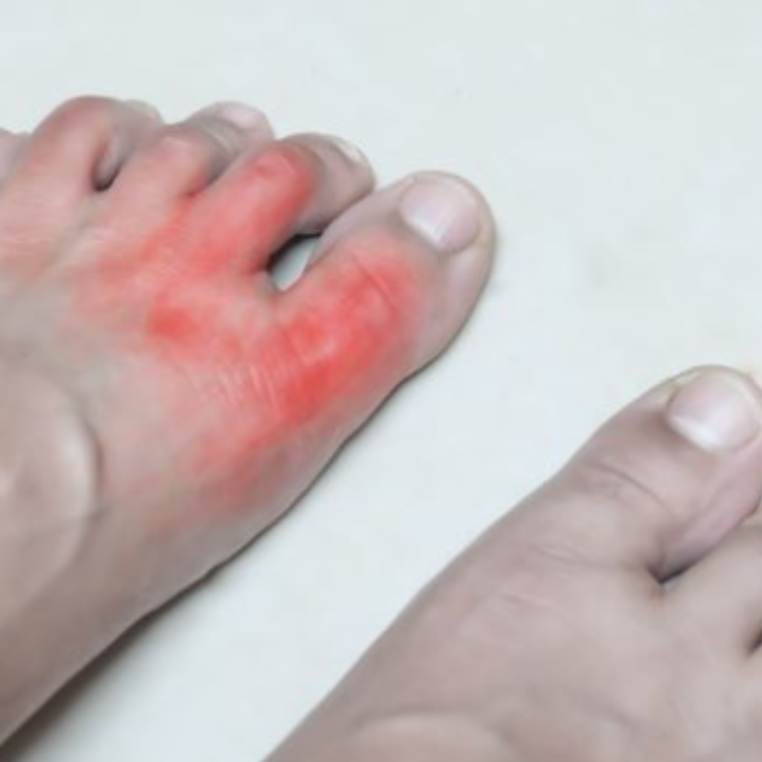 picture of chilblains on feet, they are red and inflamed