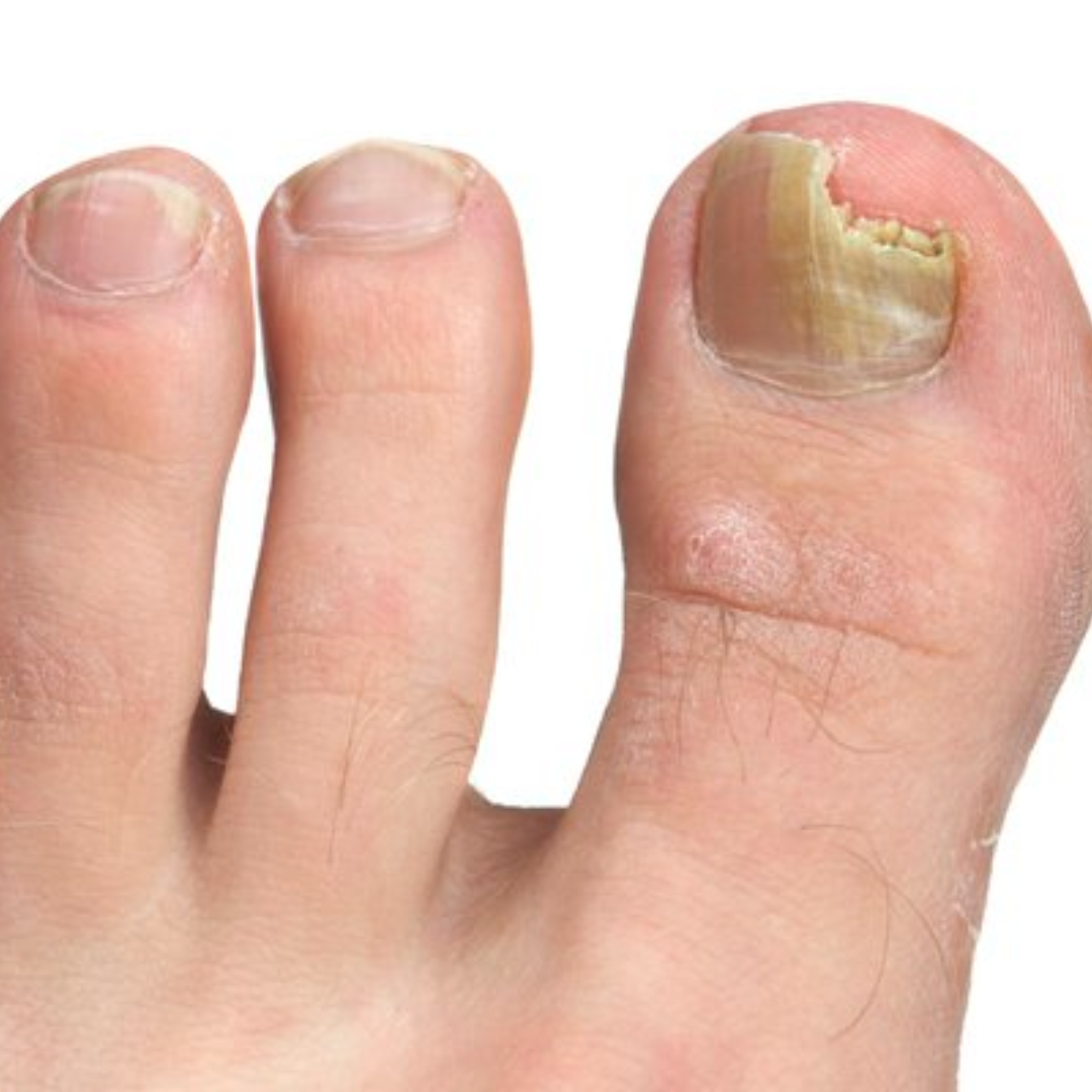 Image of a fungal toenail infection