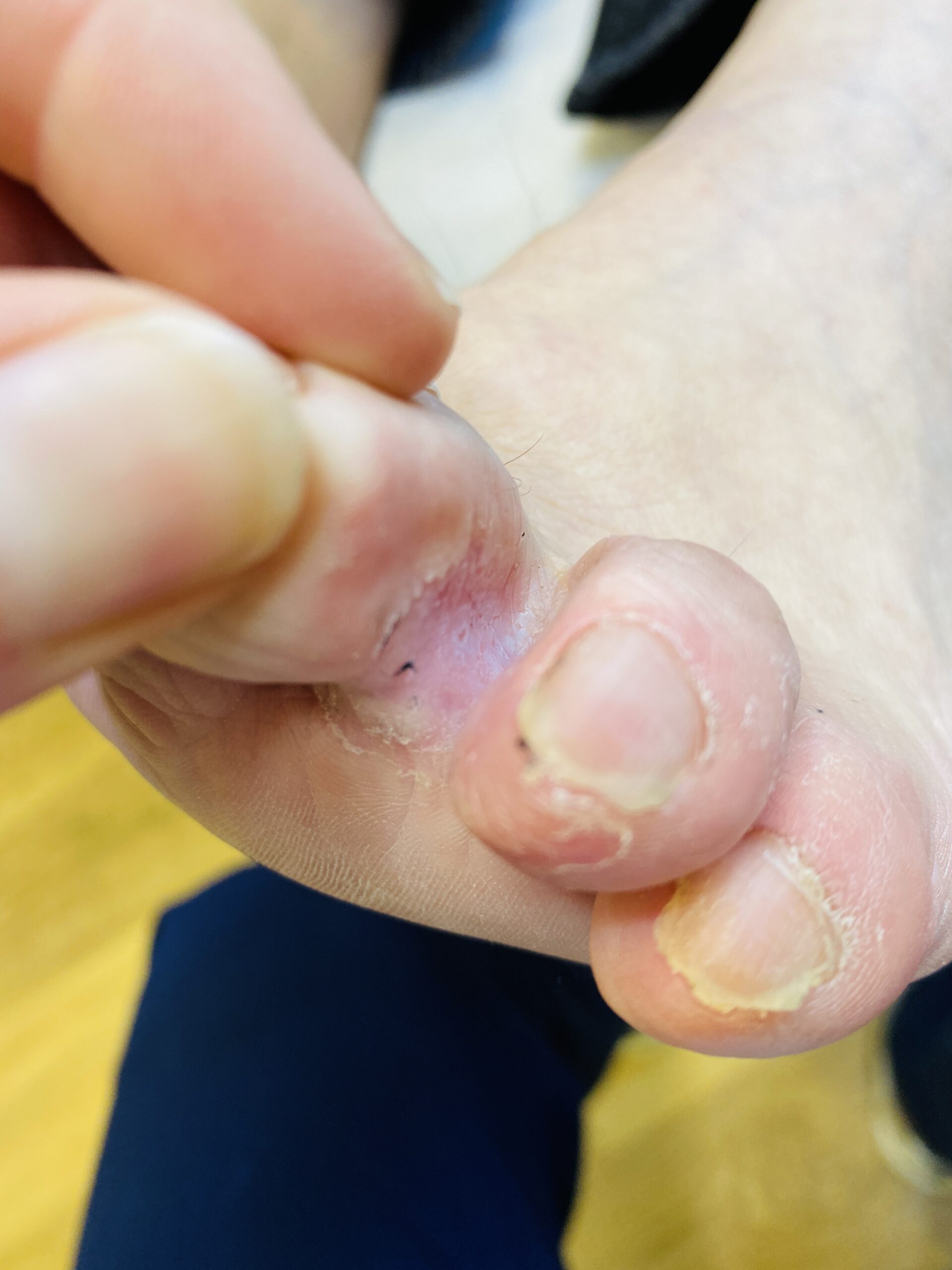athletes foot Athletes foot between toes
